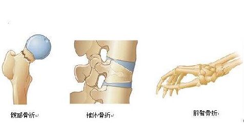 超声骨密度检测仪关注骨质疏松症，重视骨骼健康