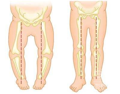 儿童骨密度仪厂家预防宝宝发生O型腿的注意事项