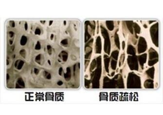 骨密度检测仪厂家-山东国康提醒常做“健骨操”,防止骨质疏松 骨密度检测仪厂家-山东国康提醒常做“健骨操”,防止骨质疏松