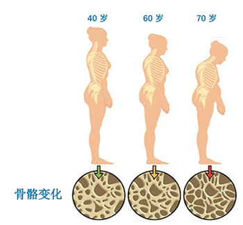 便携式骨密度检测仪厂家谈骨密度的数值越高越好吗