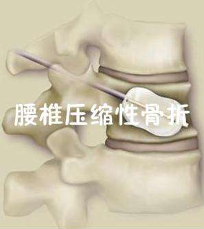 超声骨密度仪品牌山东国康建议腰椎骨裂了吃啥修复快?