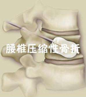 超声骨密度仪品牌山东国康建议腰椎骨裂了吃啥修复快? 超声骨密度仪品牌山东国康建议腰椎骨裂了吃啥修复快?
