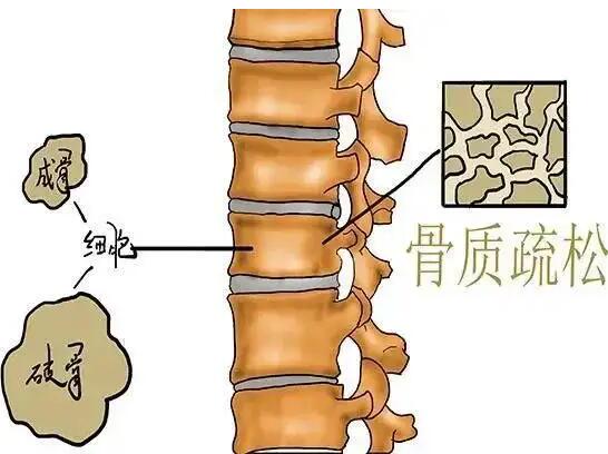 儿童骨密度仪器厂家提示中老年骨质疏松该怎么办？恰当补钙很重要