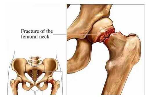 骨密度检测仪厂家提示为什么髋部骨折会称之为“人生道路最后一次骨折”？