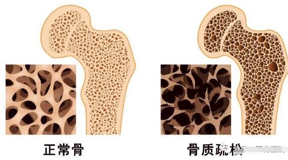 超声波骨密度仪器生产厂家提醒骨折——骨质疏松症的严重后果