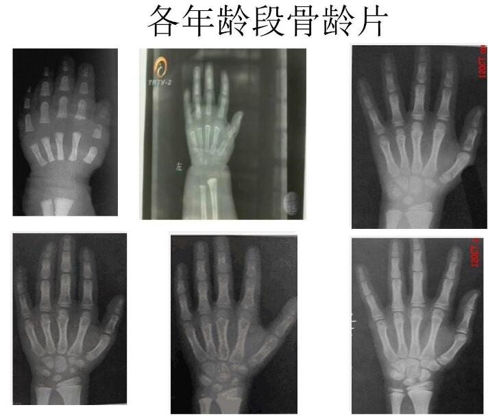 5月国康新推荐!儿童便携式骨密度检测仪品牌分析骨龄低的含义