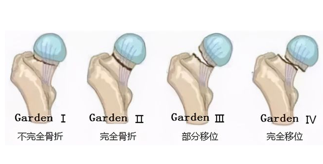 GK-7000骨密度检测仪生产厂家介绍老年人股骨颈骨折如何医治