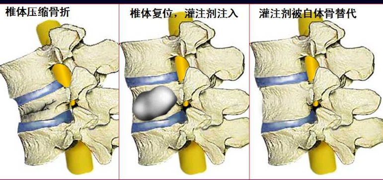 国产骨密度测试仪器品牌国康提醒一滑就可能导致腰椎骨折应该重视骨密度测试!